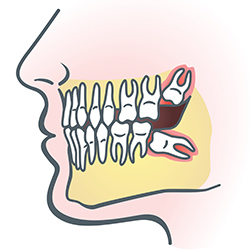 Image showing impacted wisdom teeth