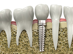 A dental implant composed of a titanium implant body and a tooth-colored crown. The implant is surgically placed into the jawbone and provides a stable foundation for the crown, which is custom-made to match the natural teeth.