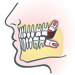 wisdom teeth In mouth side view.